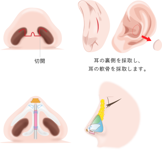 耳介軟骨移植の画像