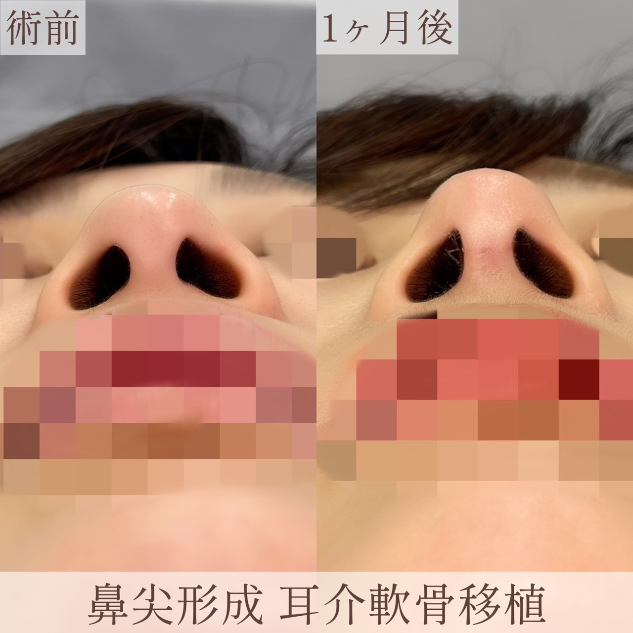 耳介軟骨移植+鼻尖形成の画像