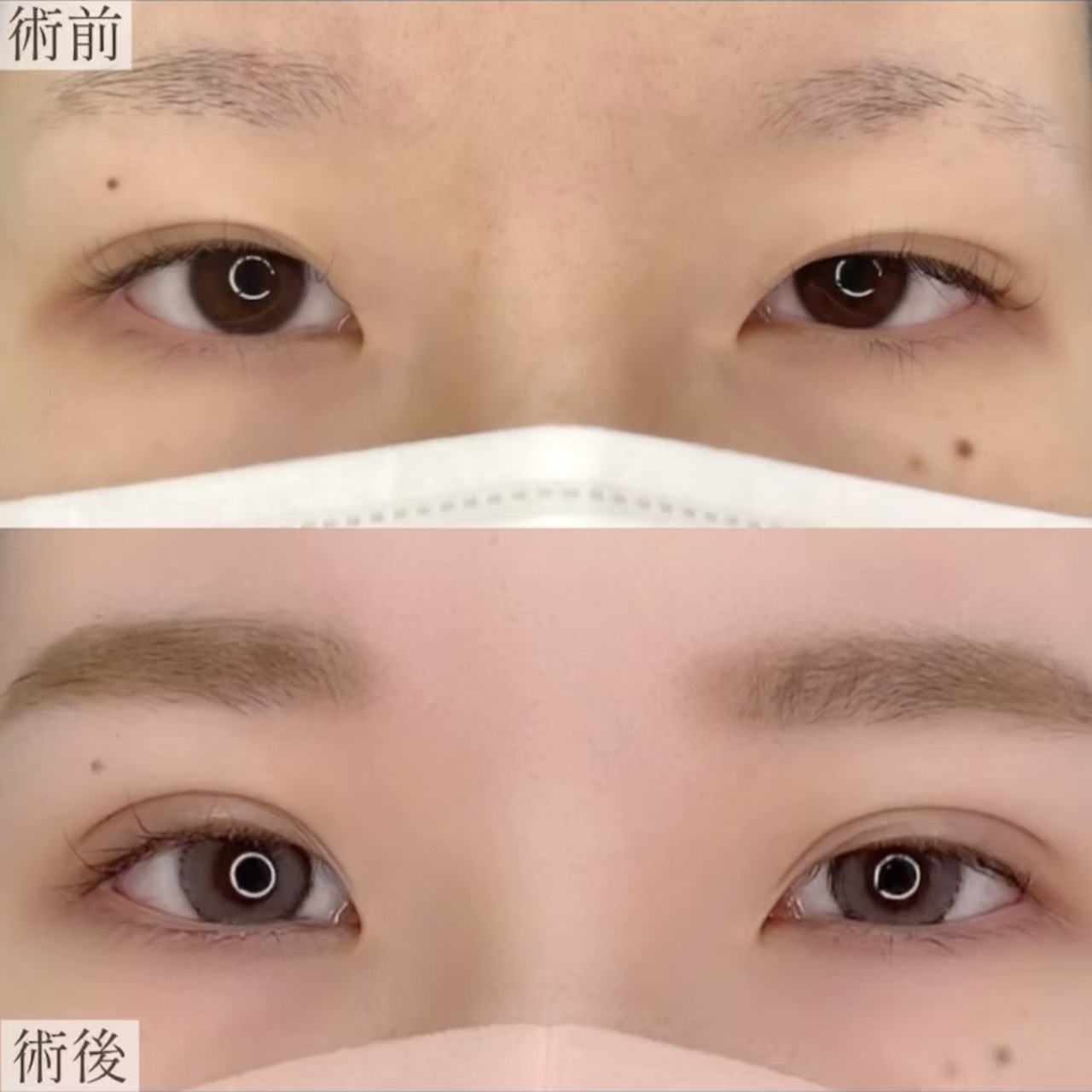 【二重埋没法】自然癒着法の画像