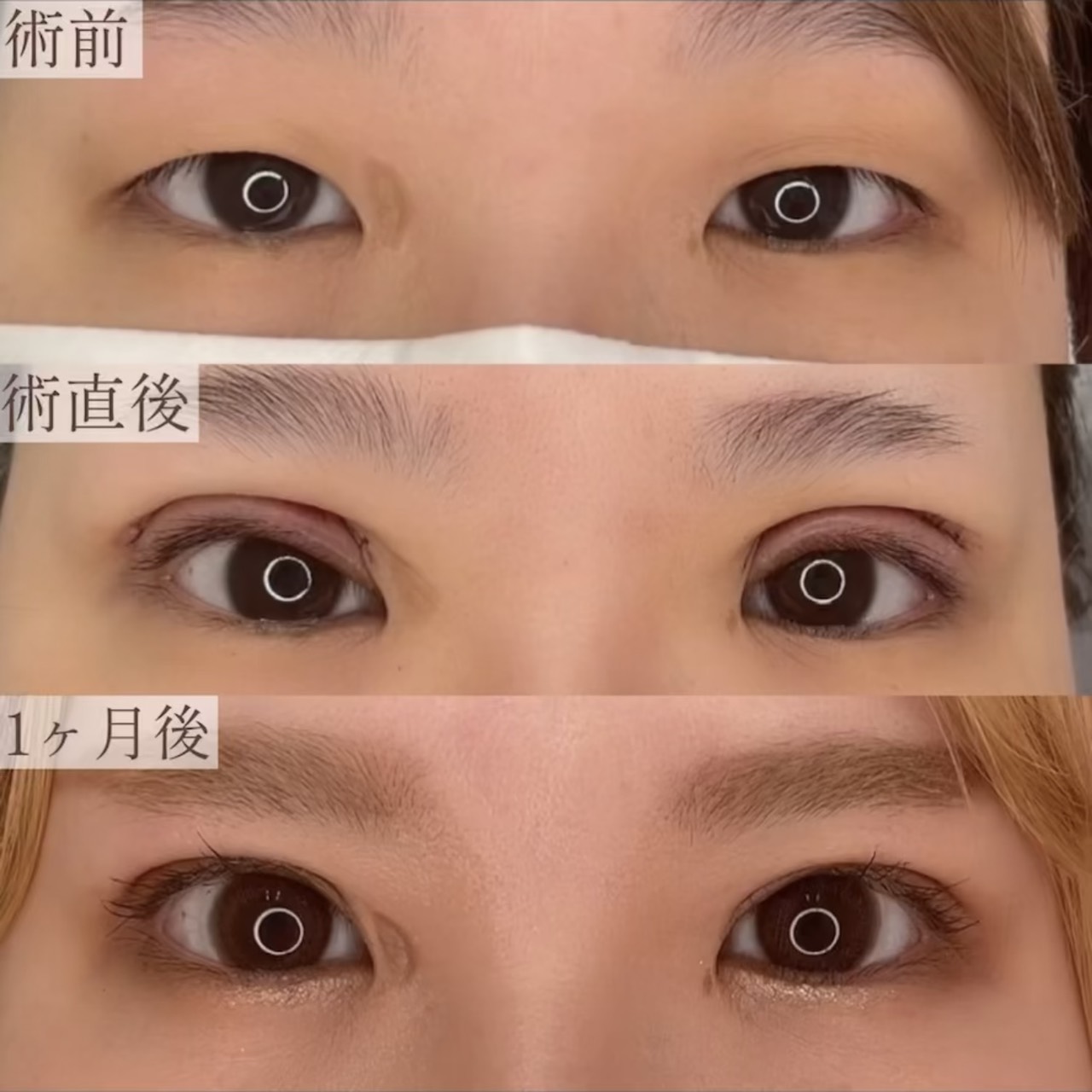 眼瞼下垂併用全切開の画像