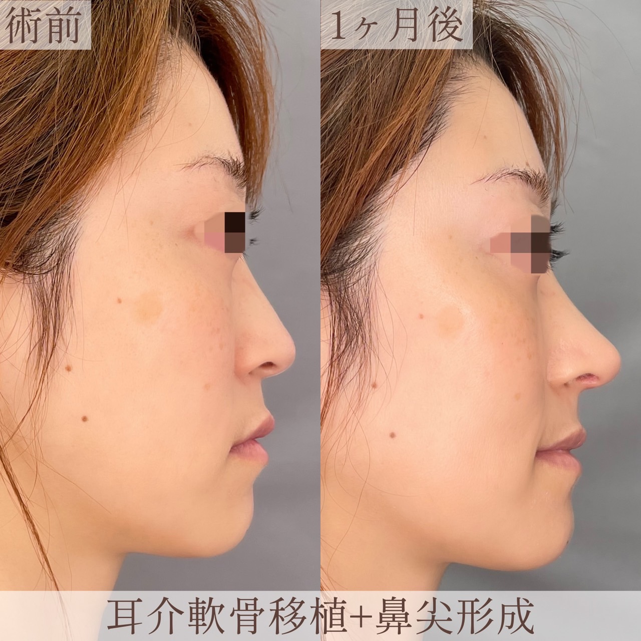 鼻尖形成+耳介軟骨移植(1ヶ月後)の画像