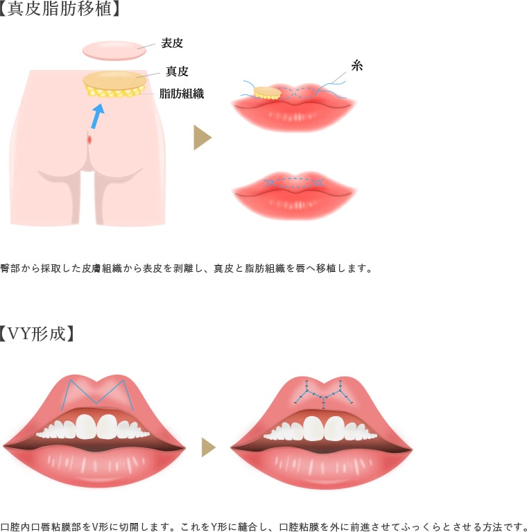 口唇増大の画像