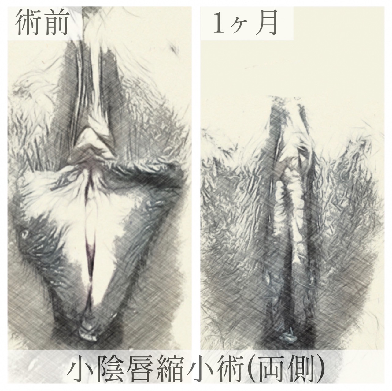 小陰唇の画像