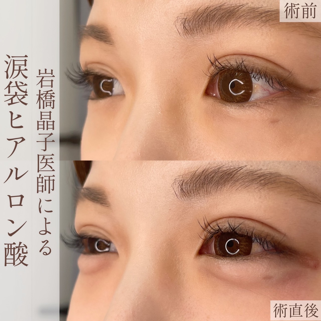 涙袋ヒアルロン酸の画像