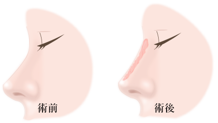 鼻筋筋膜移植の画像