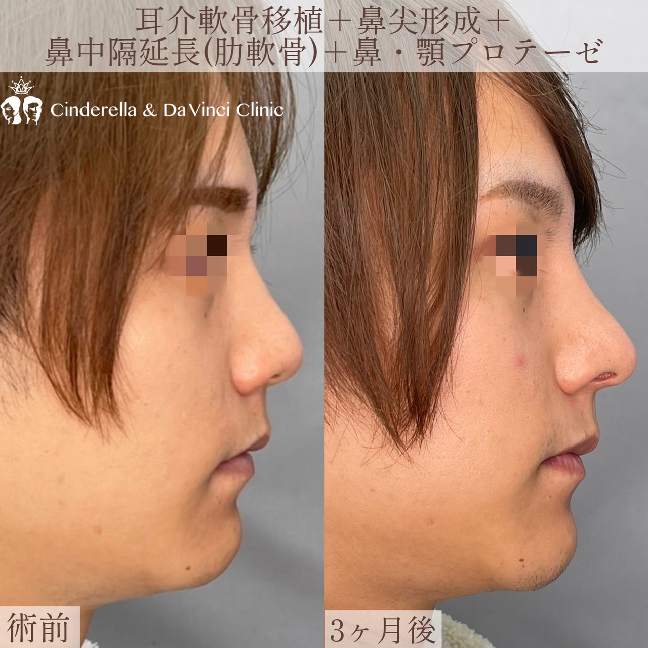 (耳介軟骨移植+鼻尖形成+鼻中隔延長(肋軟骨)+鼻・顎プロテーゼ)の画像