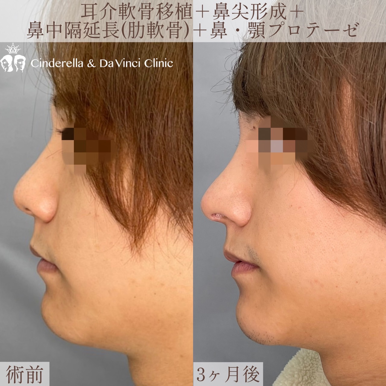 （耳介軟骨移植＋鼻尖形成＋鼻中隔延長(肋軟骨)＋鼻・顎プロテーゼ）の画像