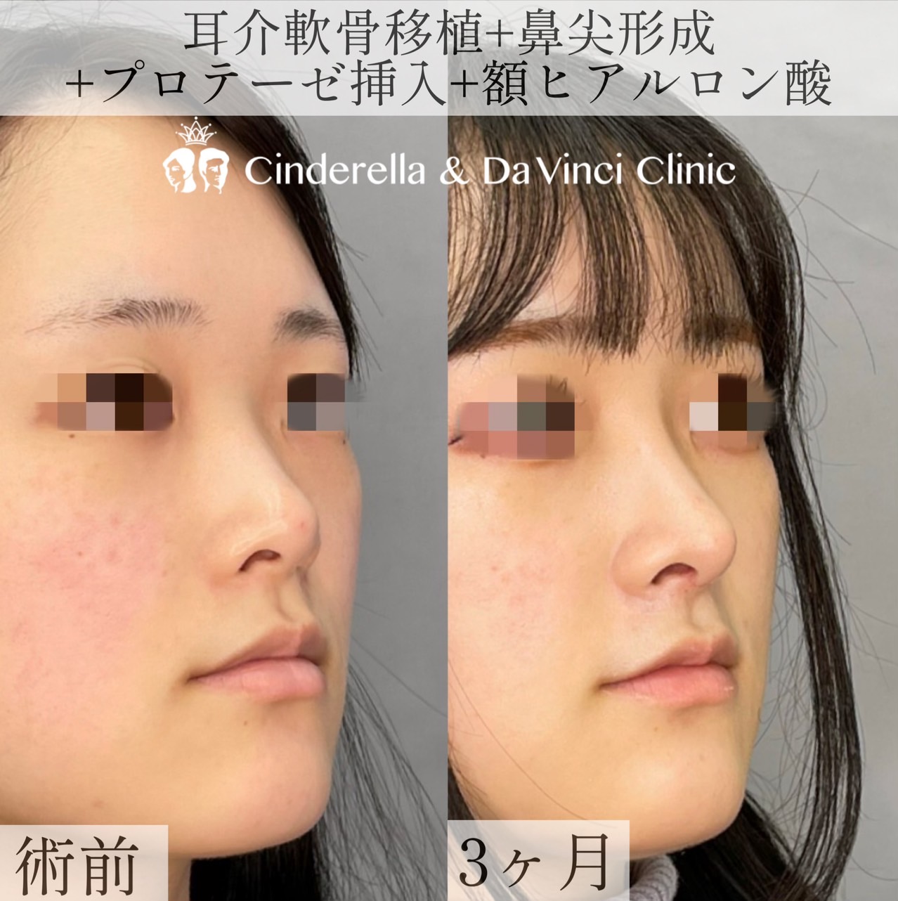 (耳介+鼻尖+プロテ+額ヒアル)の画像