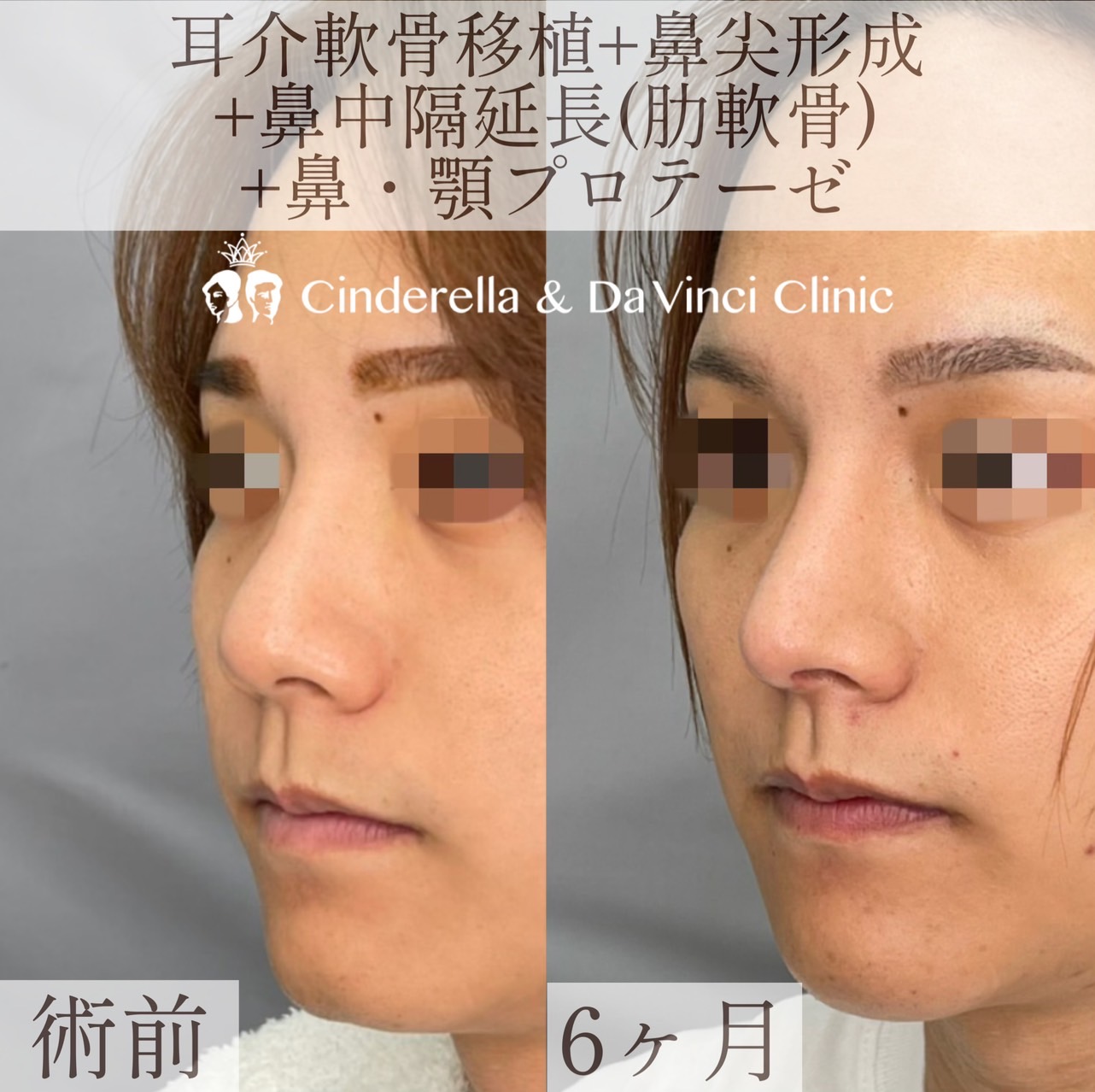 耳介軟骨移植＋鼻尖形成＋鼻中隔延長(肋軟骨)＋鼻・顎プロテーゼの画像