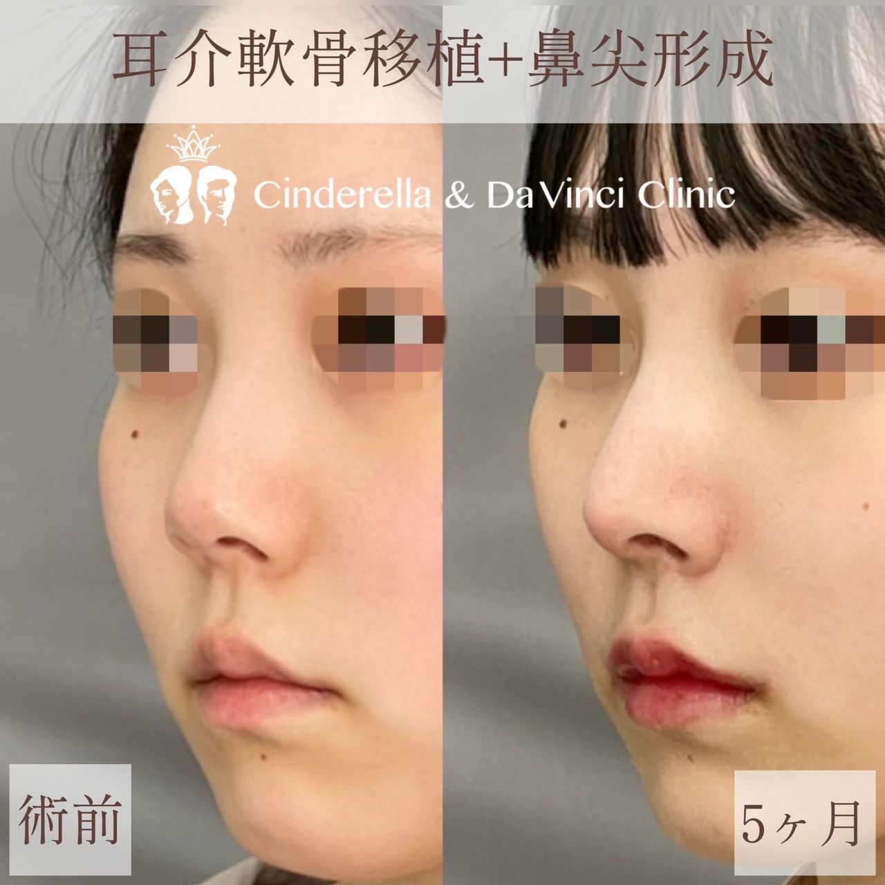【1ヶ月】耳介軟骨移植+鼻尖形成【20代女性】の画像