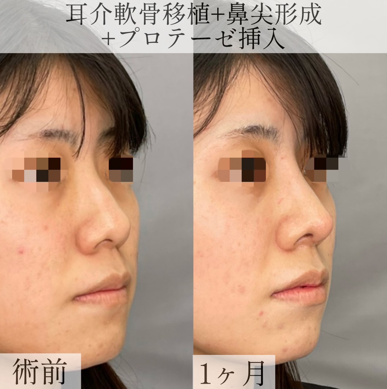 【1ヶ月】耳介軟骨移植+鼻尖形成+プロテーゼ挿入【20代女性】の画像