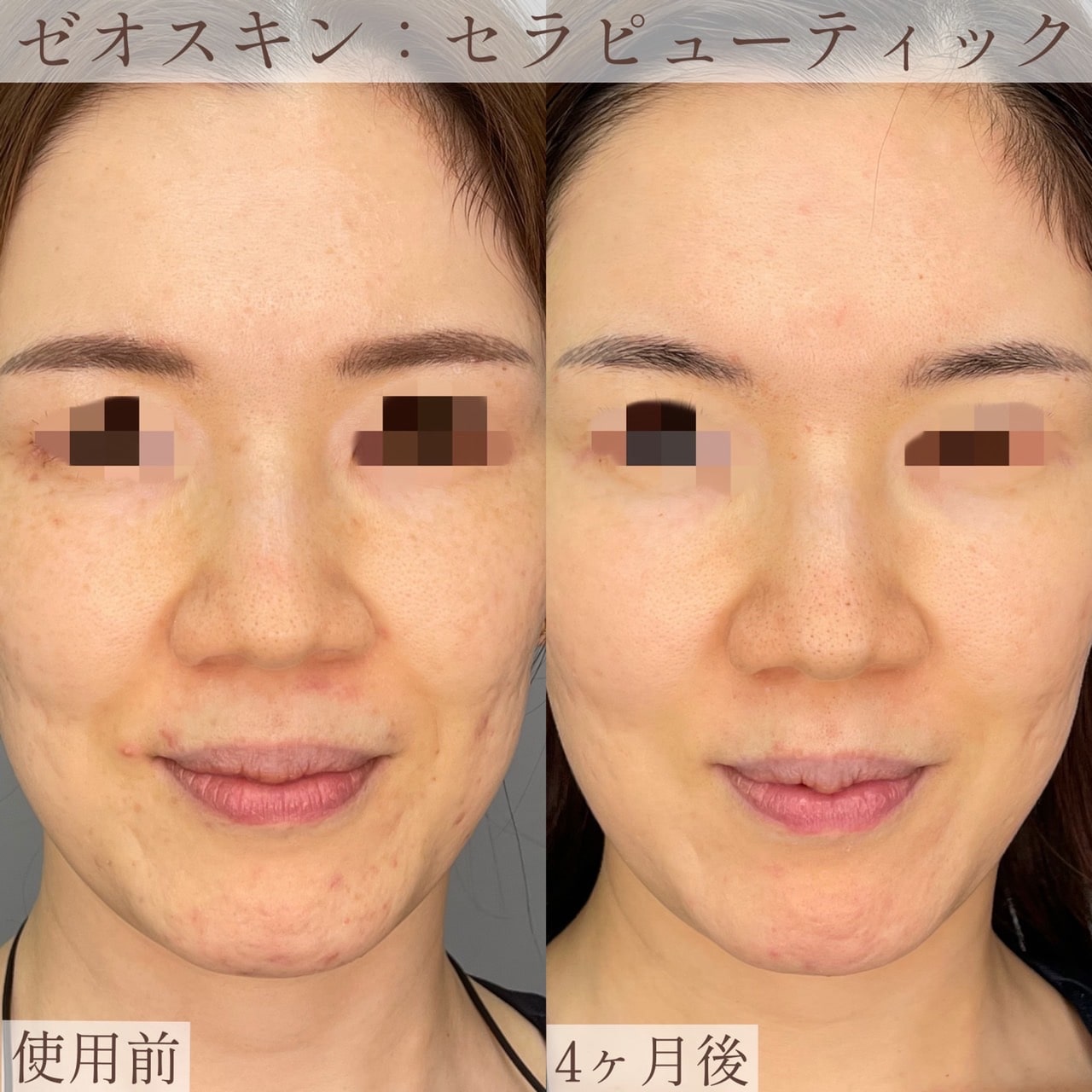 ゼオスキン　使いかけ ゼオスキンのセラピューテックプログラムの使用期間と辞め方について