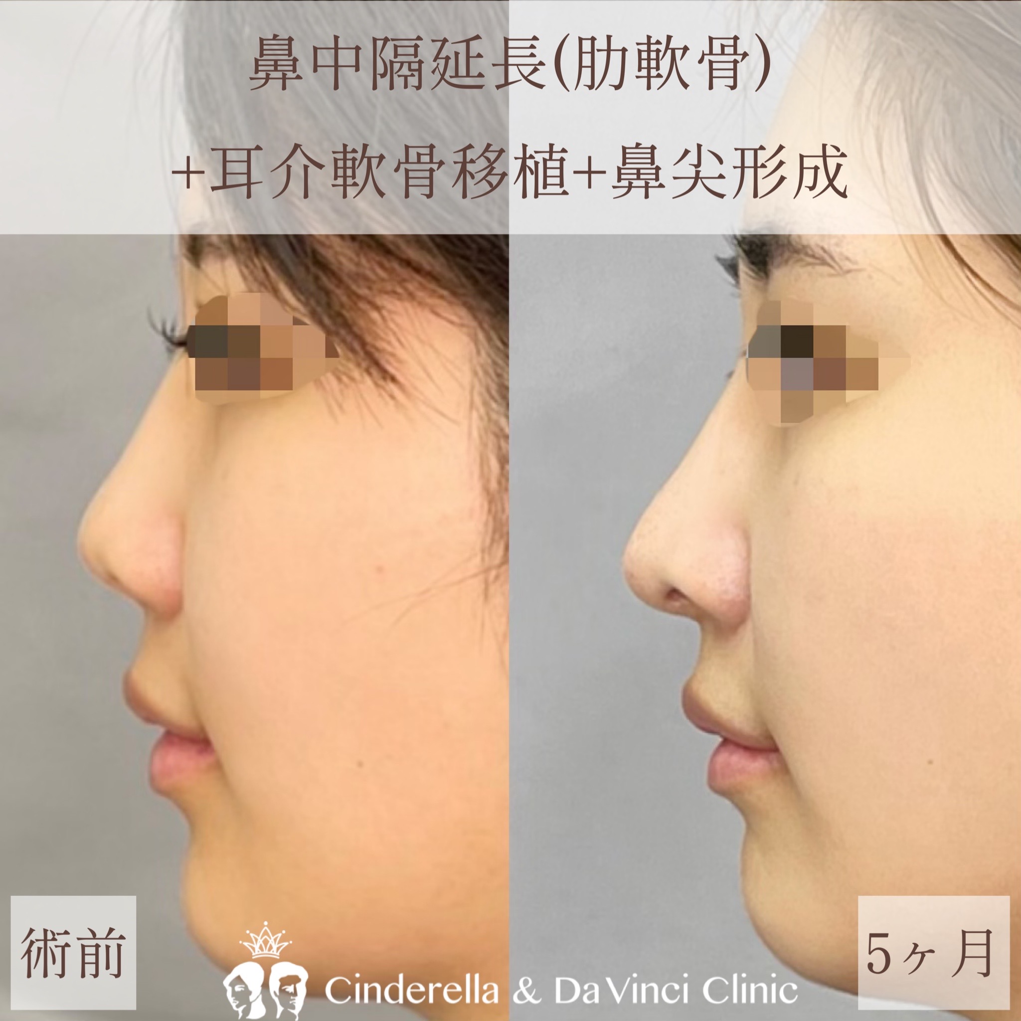 【1ヶ月】鼻中隔延長+耳介軟骨移植+鼻尖形成【20代女性】の画像