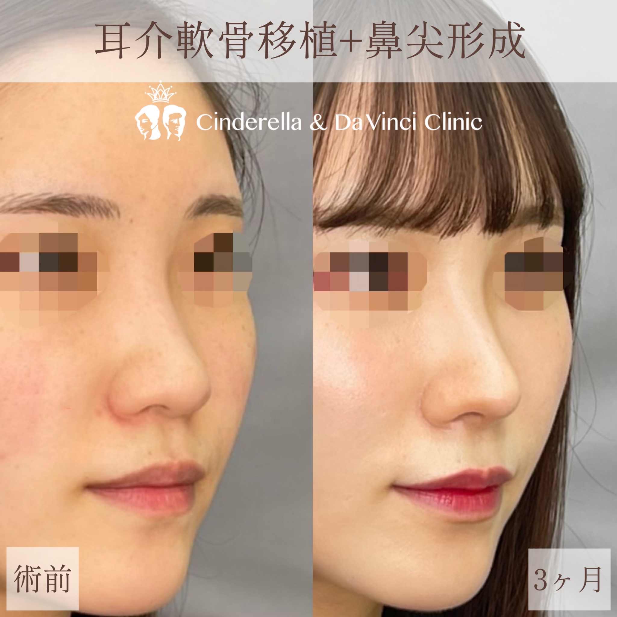 耳介軟骨+鼻尖形成【5ヶ月】の画像