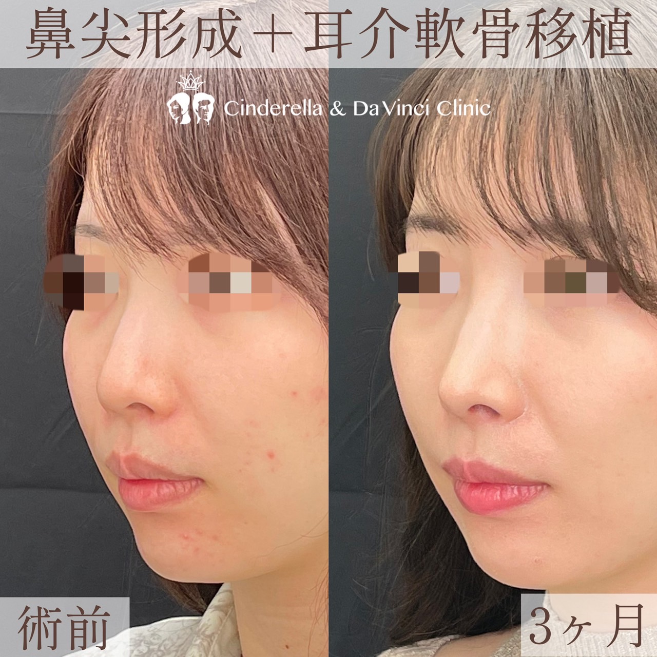 鼻先に自然な高さを出すの画像