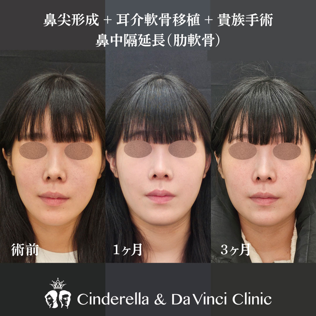 鼻整形1カ月～3ヶ月の変化の画像