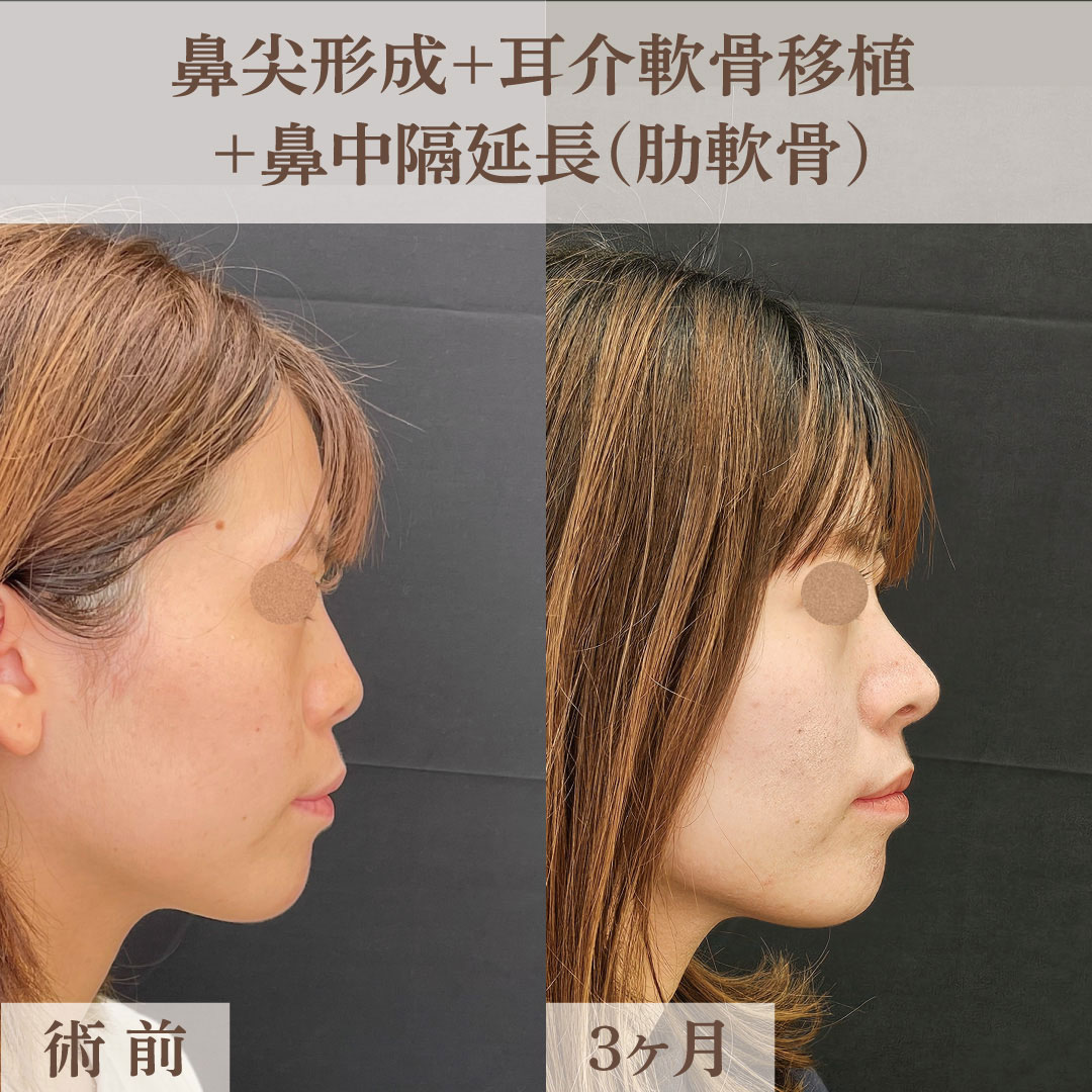 横顔を立体的にする鼻整形の画像
