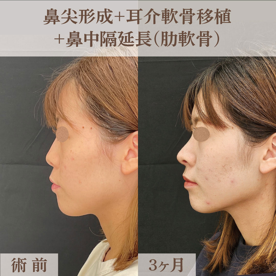 横顔を立体的にする鼻整形の画像