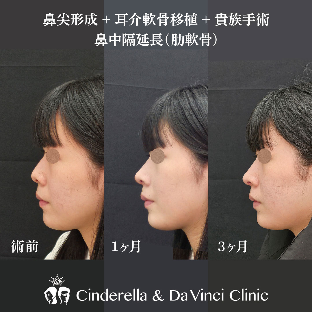 鼻整形1カ月～3ヶ月の変化の画像