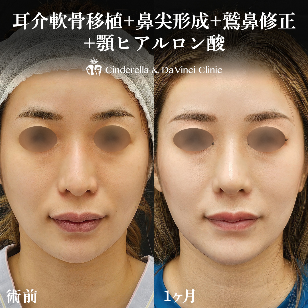 鼻と顎の同時施術でＥラインを整えるの画像