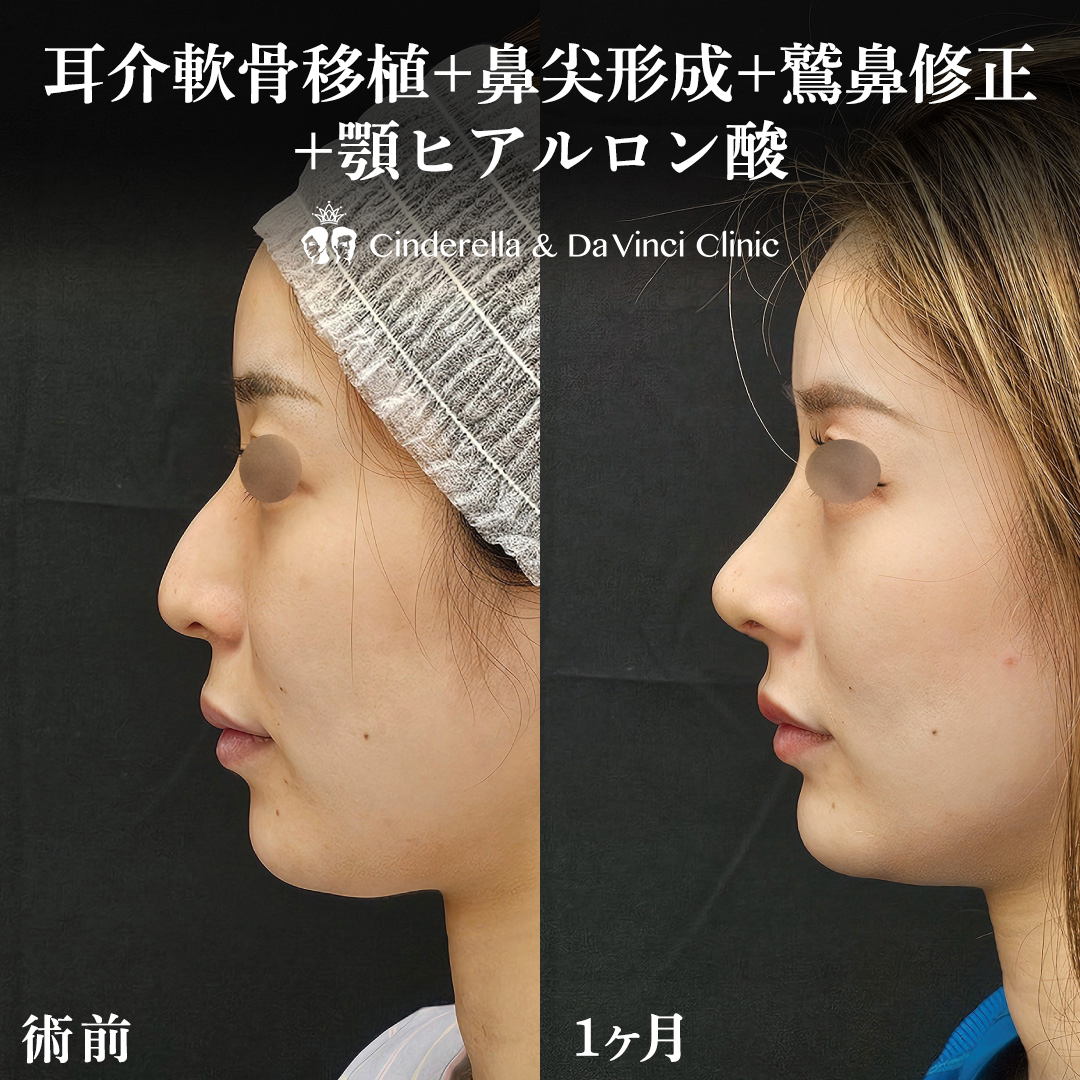 鼻と顎の同時施術でＥラインを整えるの画像