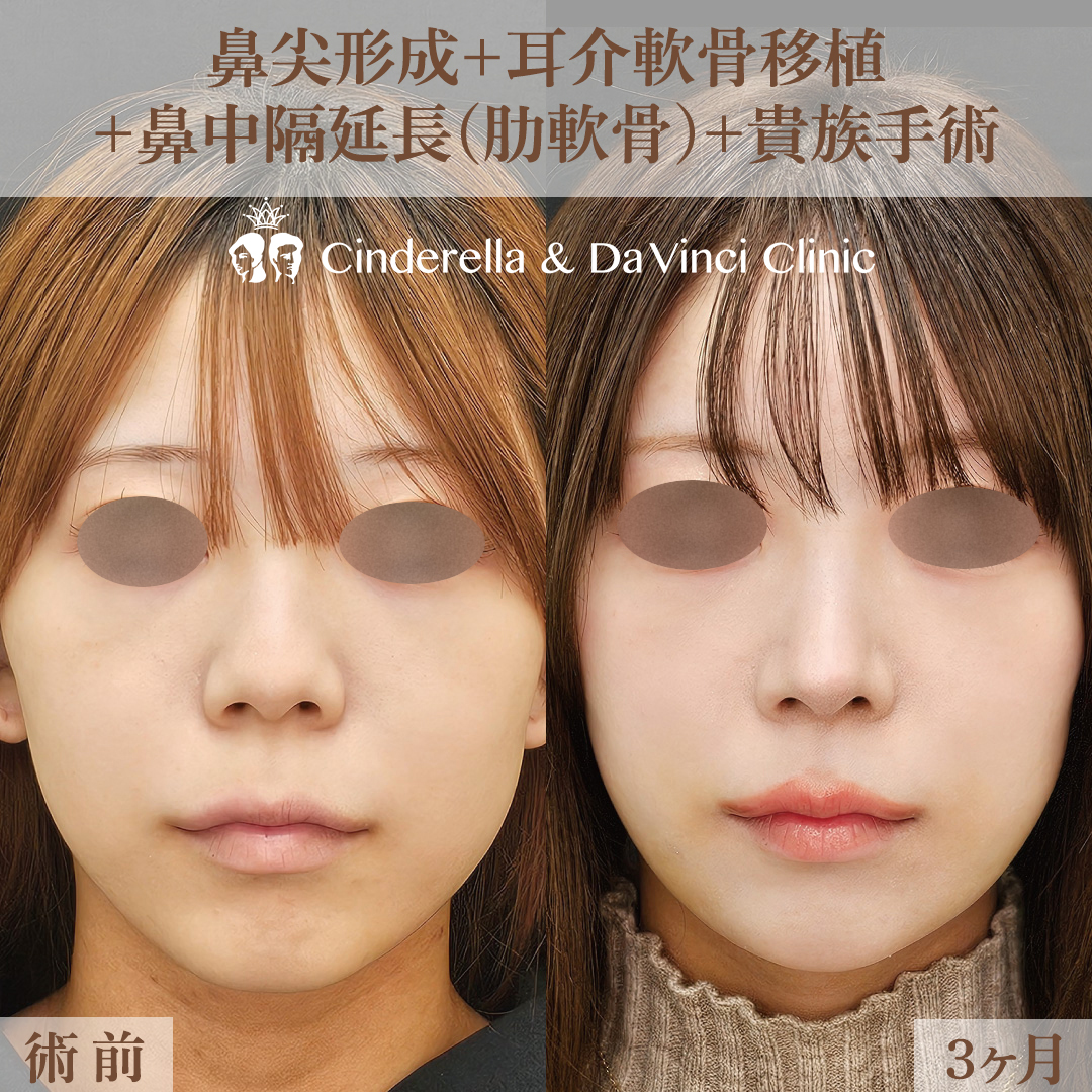 鼻整形の「貴族手術」と「猫手術」とは？効果や違い、それぞれの
