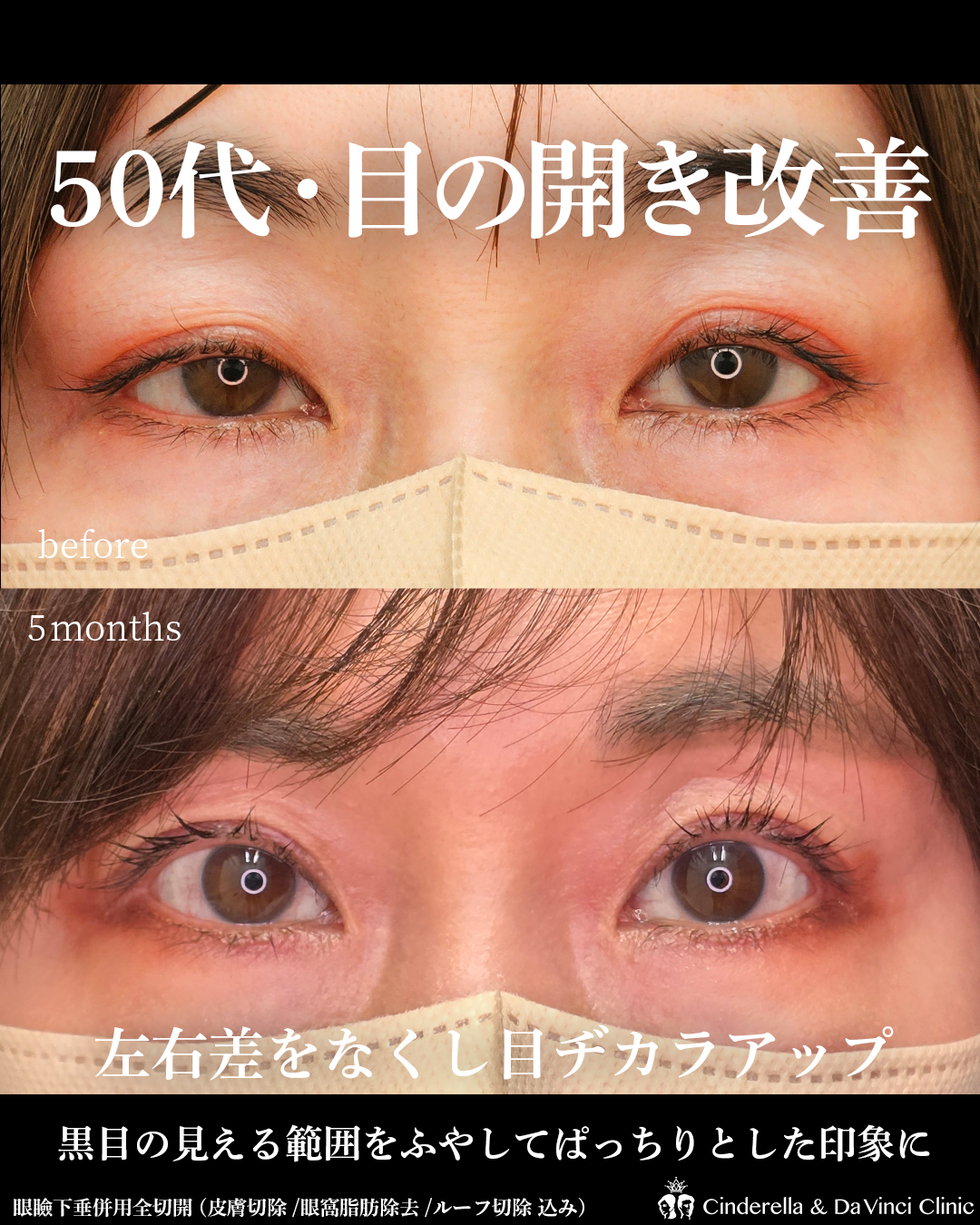 50代の目の開きを改善の画像