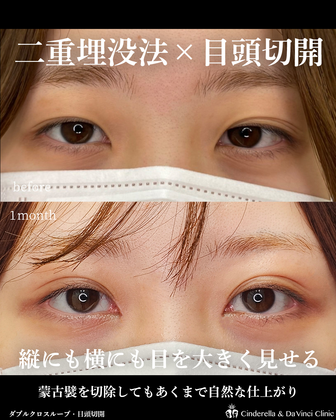 蒙古襞を切除しても自然な仕上がりの画像