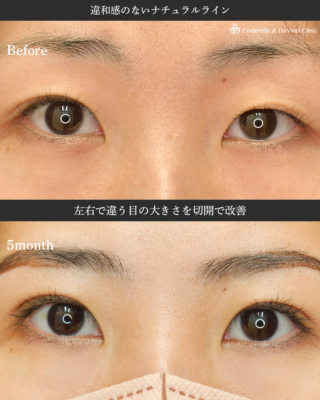 左右で違う目の大きさを切開で改善の画像