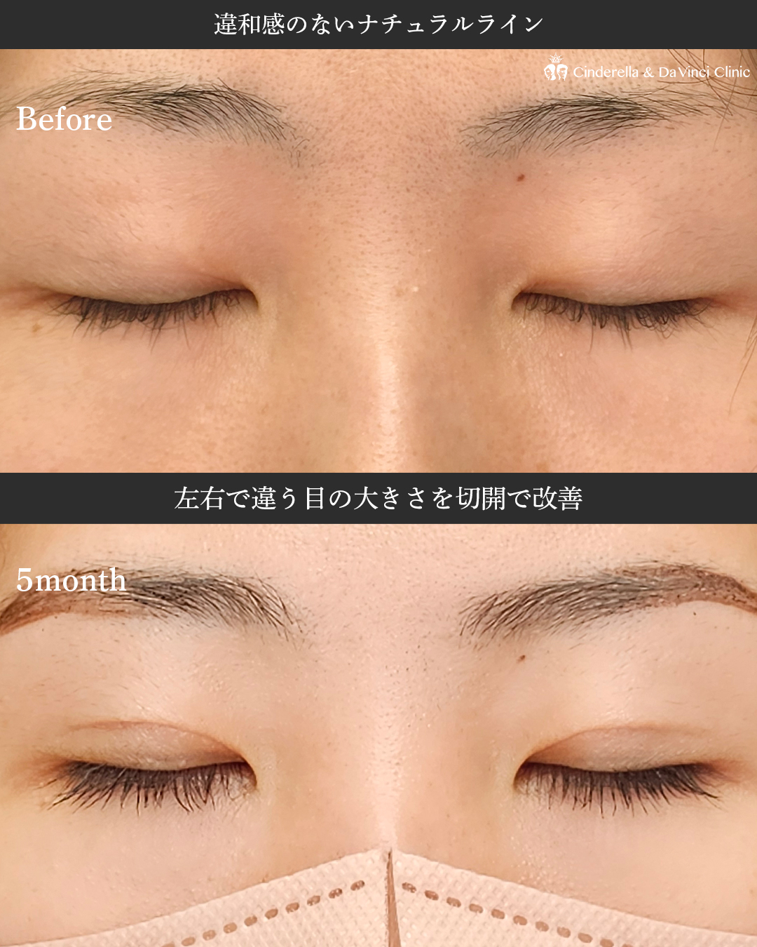 左右で違う目の大きさを切開で改善の画像