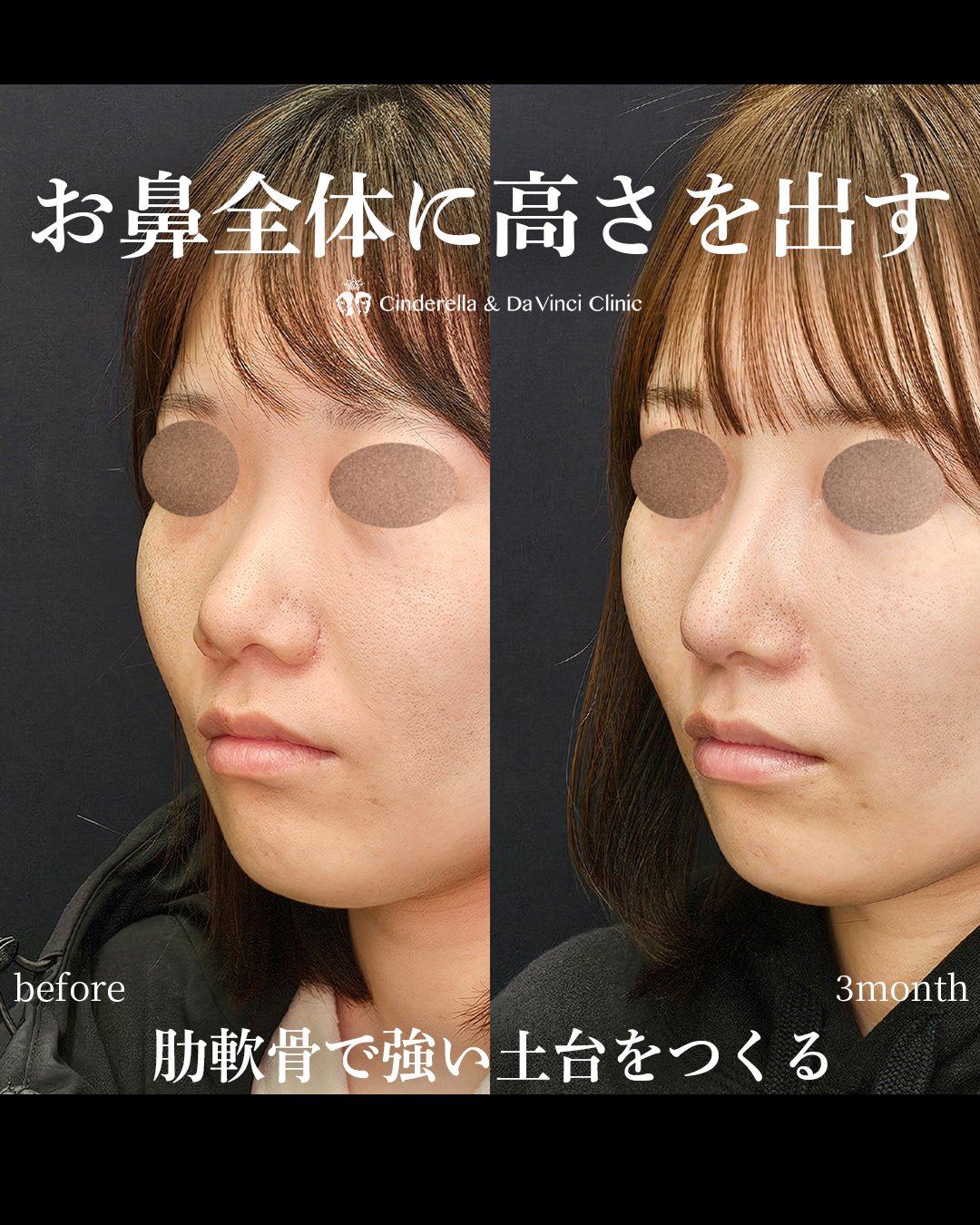 お鼻全体に高さを出すの画像
