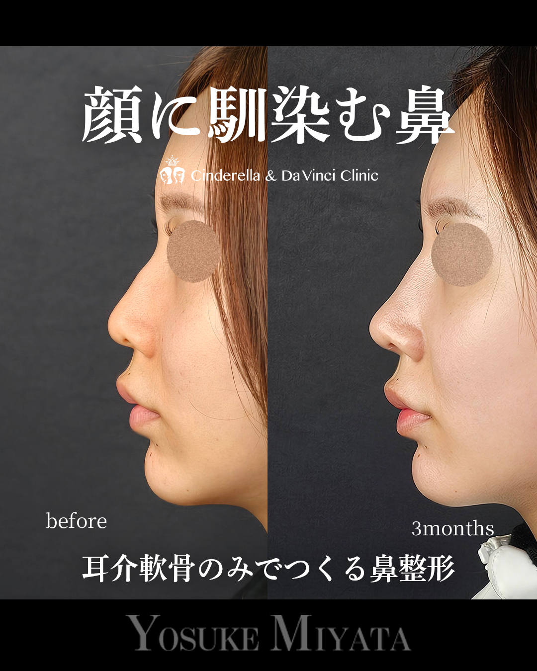 顔に馴染む鼻の画像