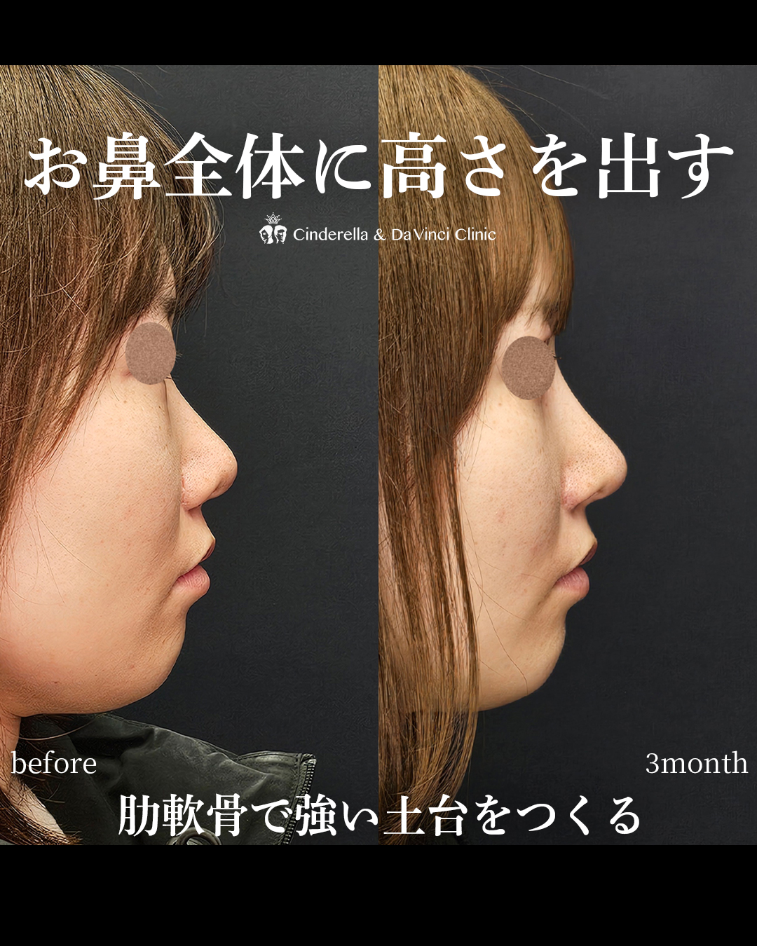 お鼻全体に高さを出すの画像