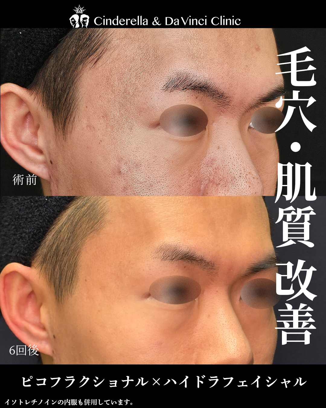 毛穴の黒ずみと毛穴詰まり改善の画像