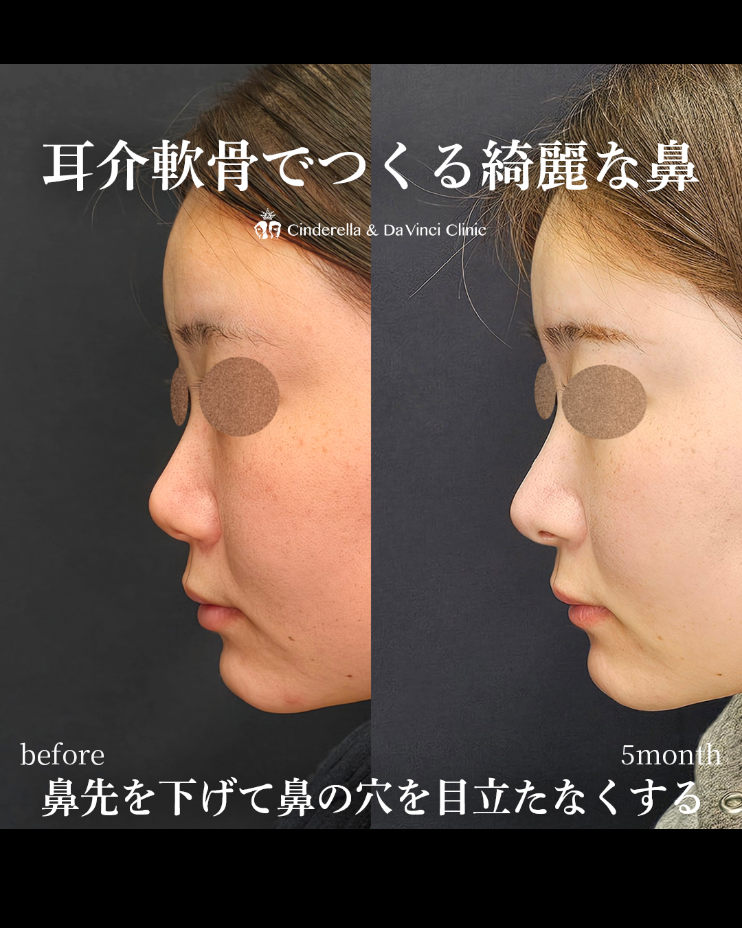 耳介軟骨でつくるナチュラル鼻整形の画像