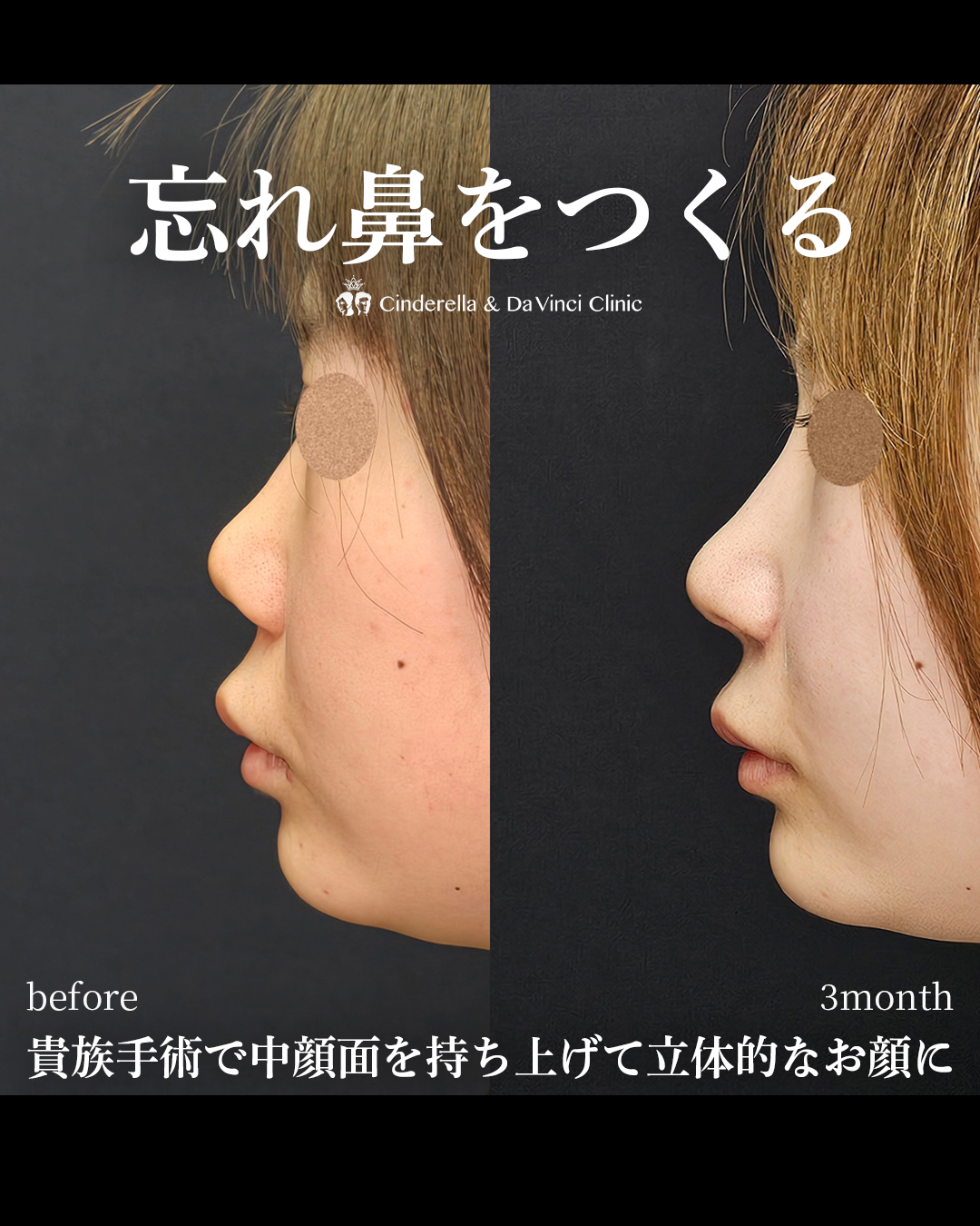 鼻の整形で正面を忘れ鼻にの画像