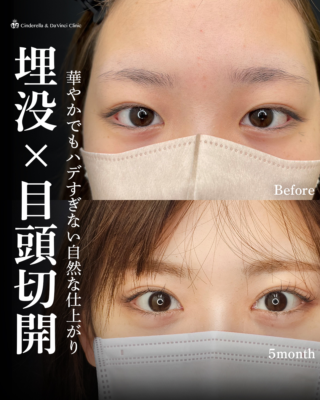 自然癒着と目頭切開を同時に手術の画像