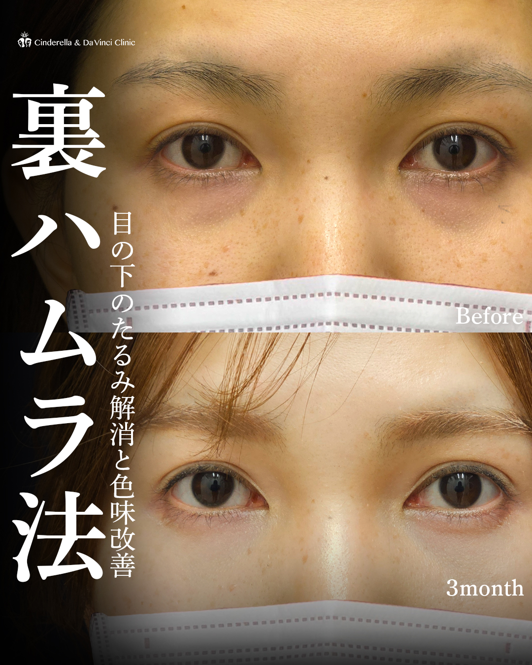 目の下のくま改善(裏ハムラ法)の画像