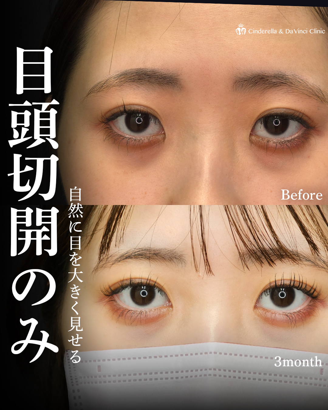 目頭切開だけで目の横幅を広げるの画像