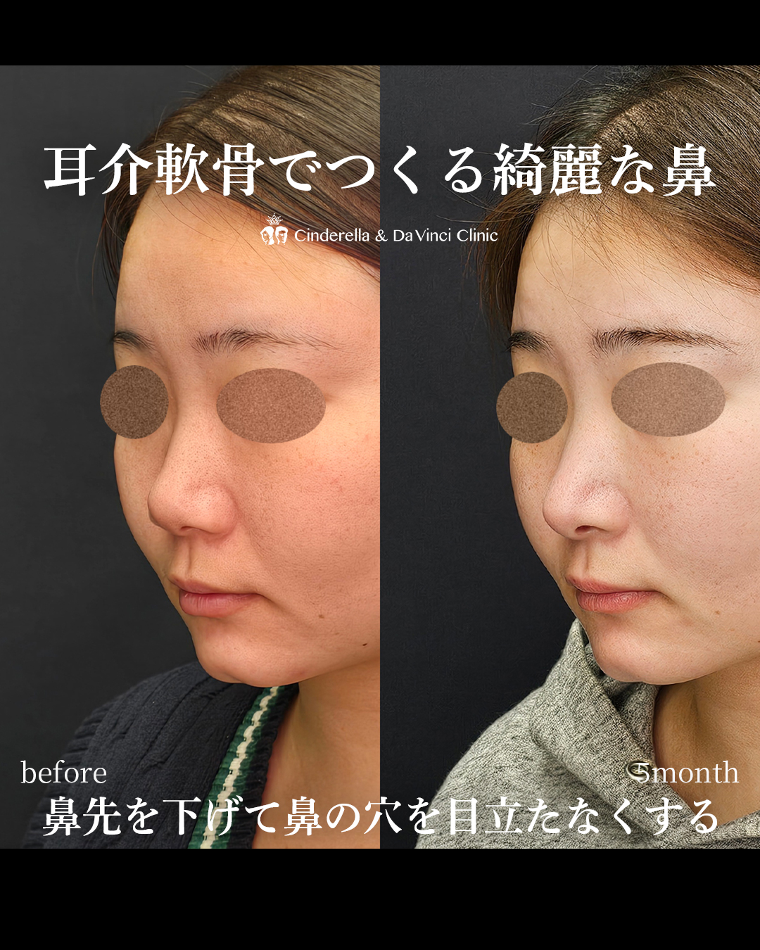 耳介軟骨でつくるナチュラル鼻整形の画像