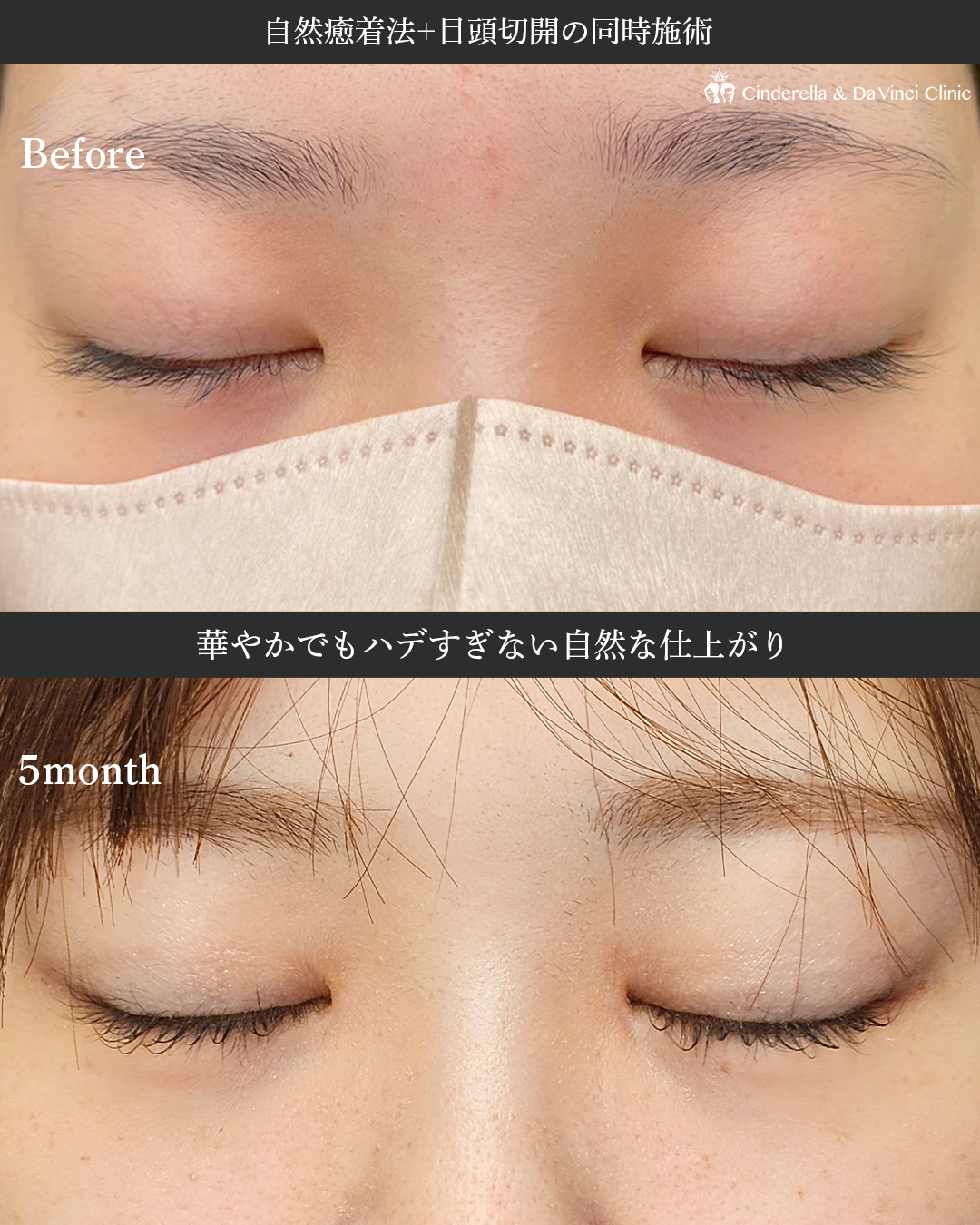 自然癒着と目頭切開を同時に手術の画像