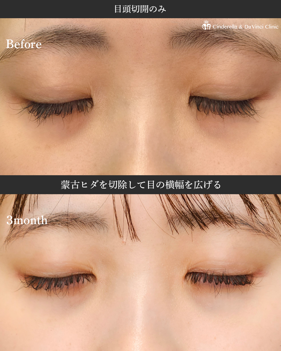 目頭切開だけで目の横幅を広げるの画像