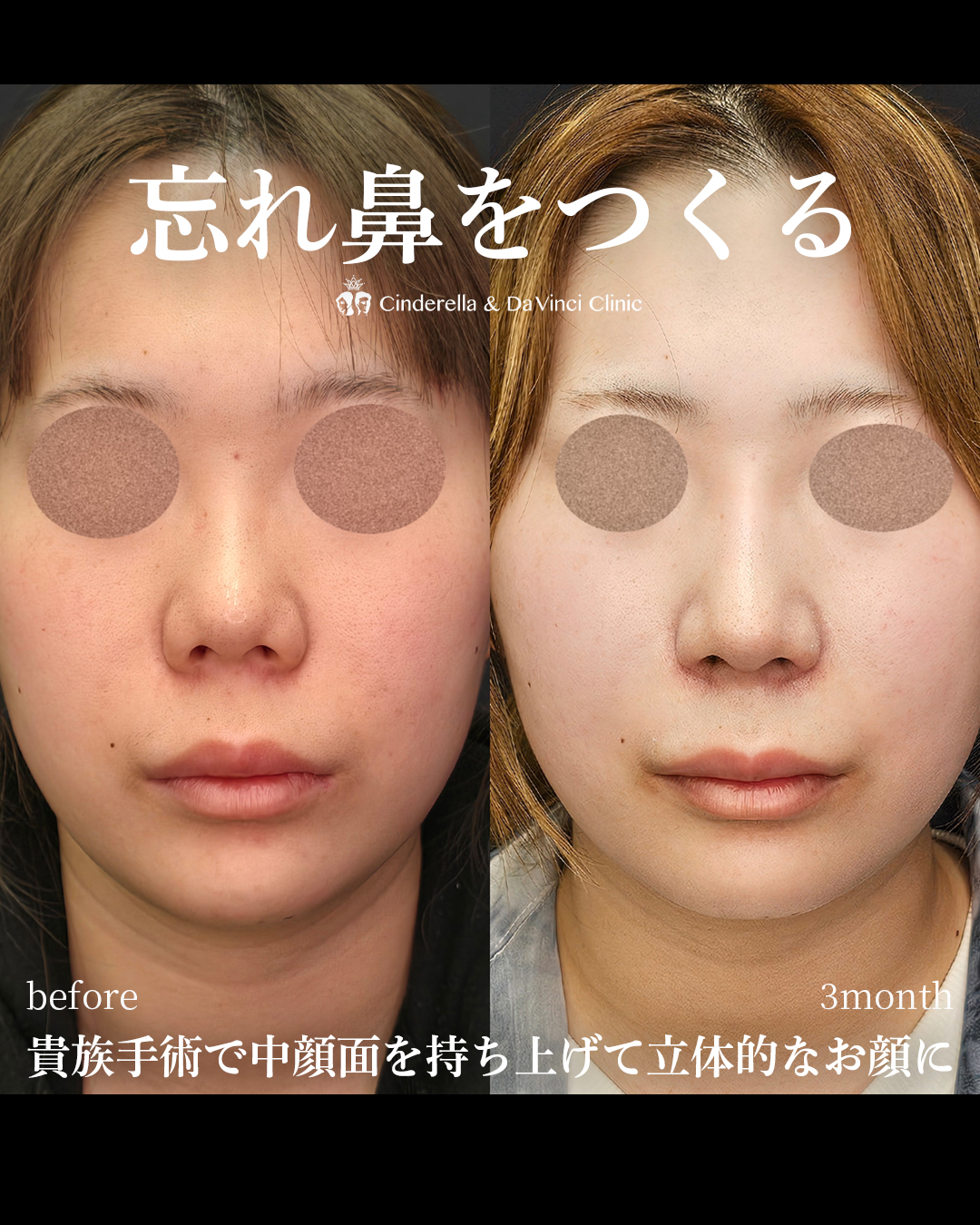 鼻の整形で正面を忘れ鼻にの画像
