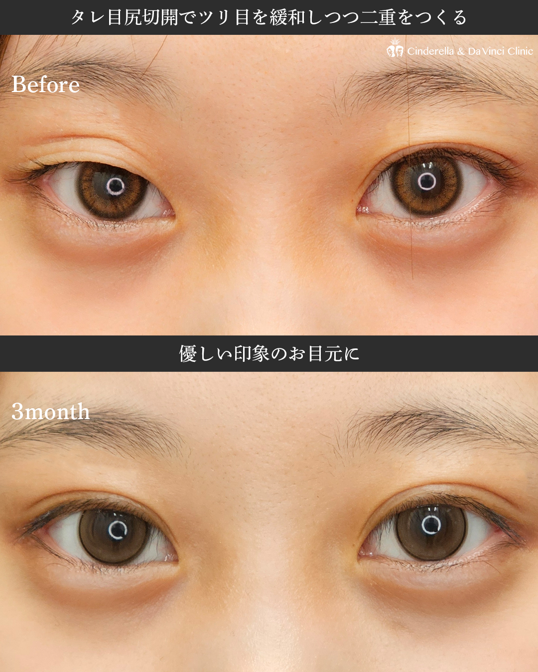タレ目尻切開×埋没で優しい目にの画像