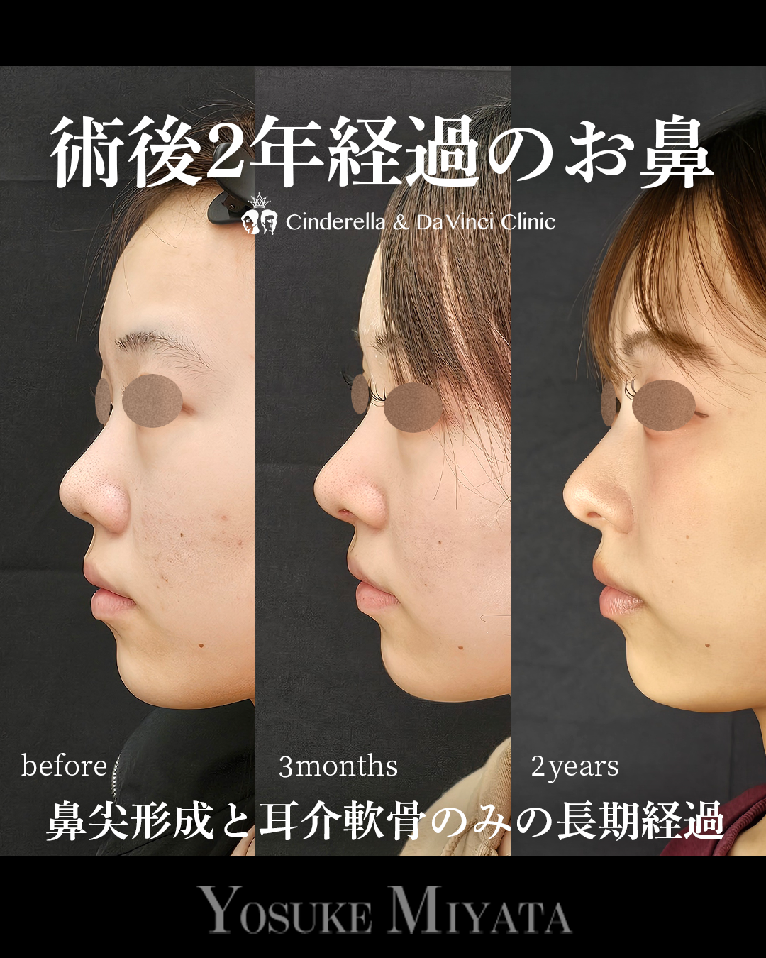 耳介軟骨だけで鼻先を下げて丸みを改善の画像