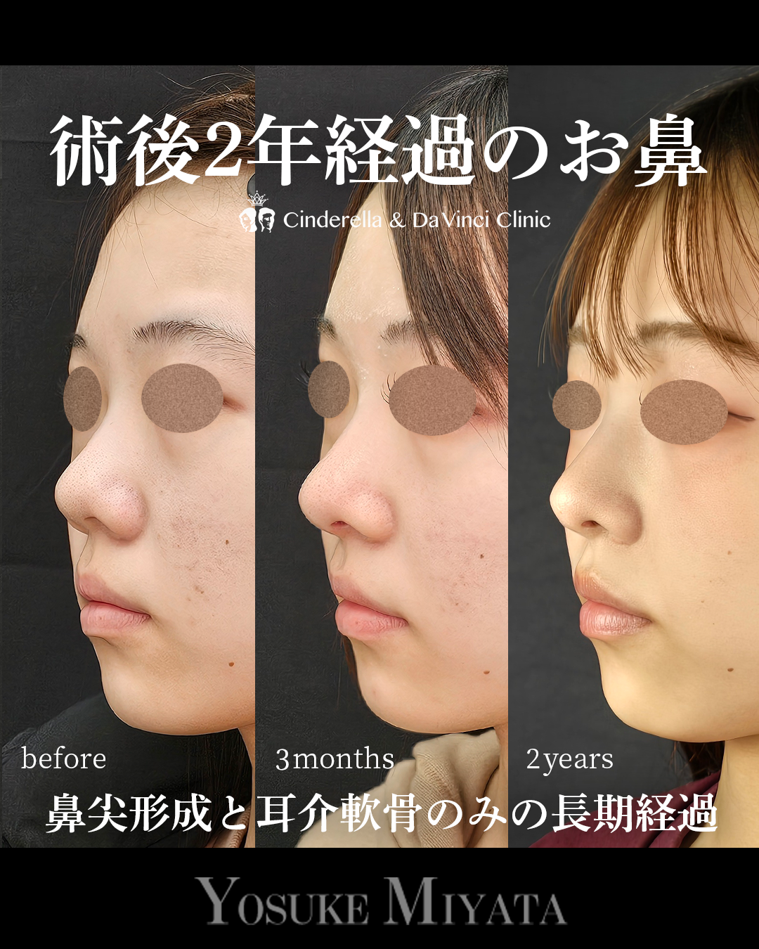 耳介軟骨だけで鼻先を下げて丸みを改善の画像