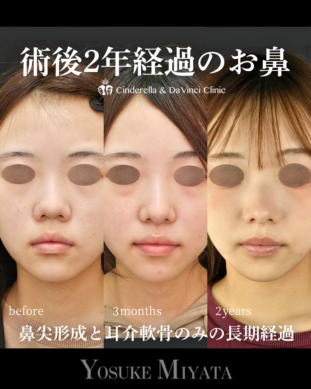 耳介軟骨だけで鼻先を下げて丸みを改善の画像