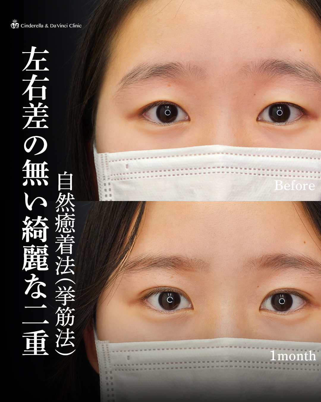 左右差の無い綺麗な二重の画像