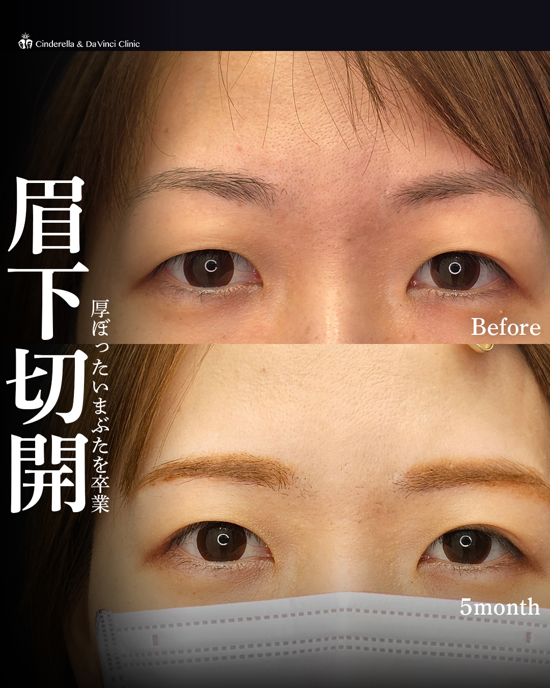 眉下切開で厚ぼったいまぶたを卒業の画像