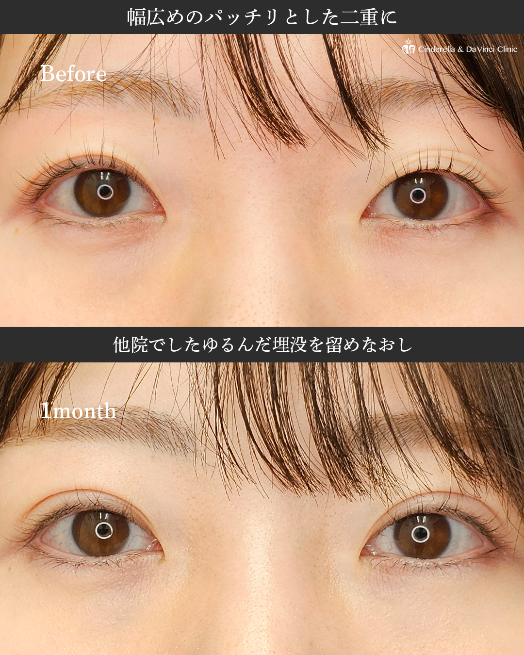 ゆるんだ埋没をパッチリ二重にの画像